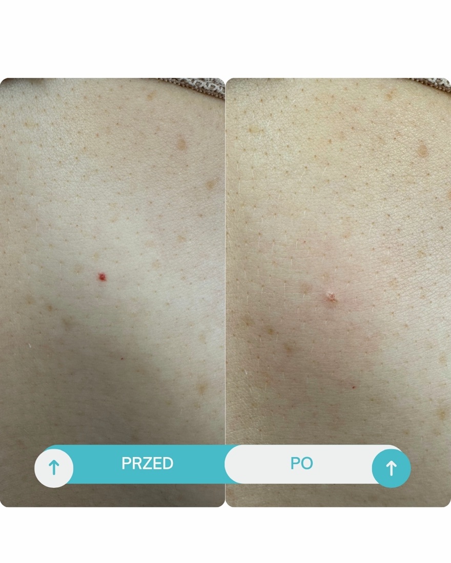 Efekt przed/po — Usunięcie rubinków